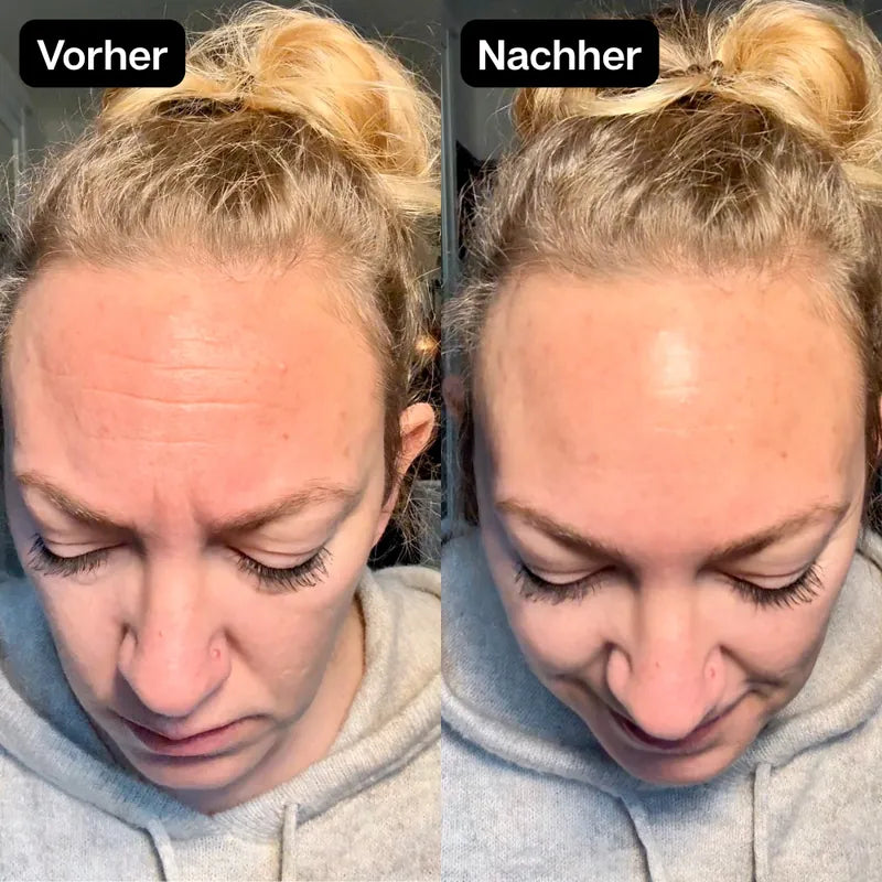 Stirn einer Kundin vorher und nachher