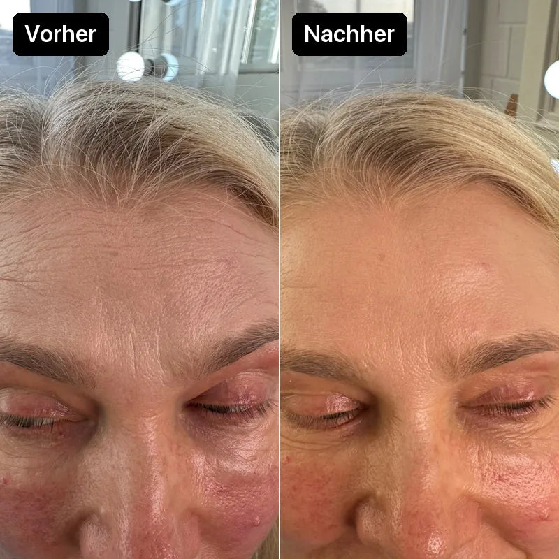 Stirn einer Kundin vorher und nachher