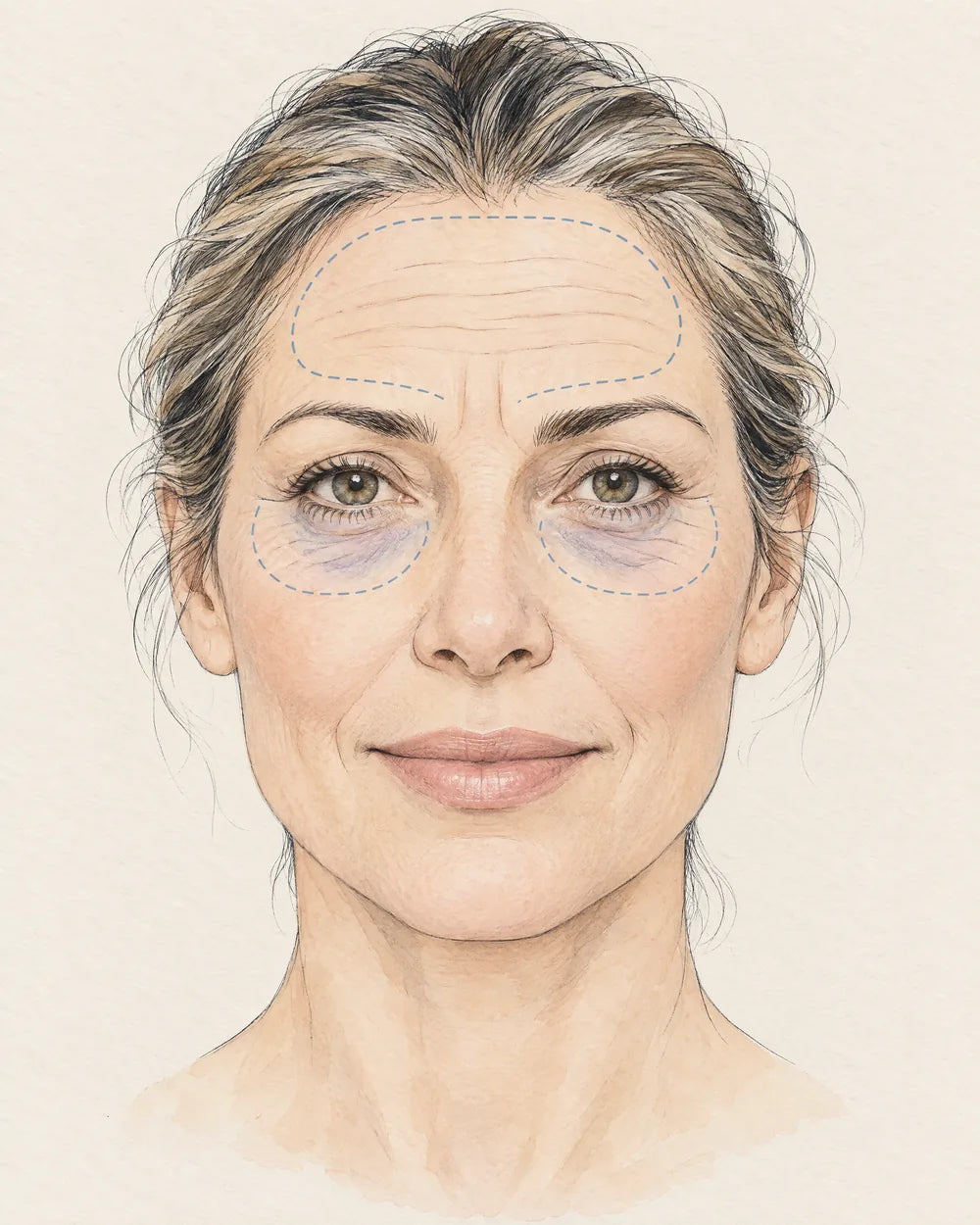 Illustration eines Gesichts mit Stirnfalten und Augenringen, beide Zonen sind markiert